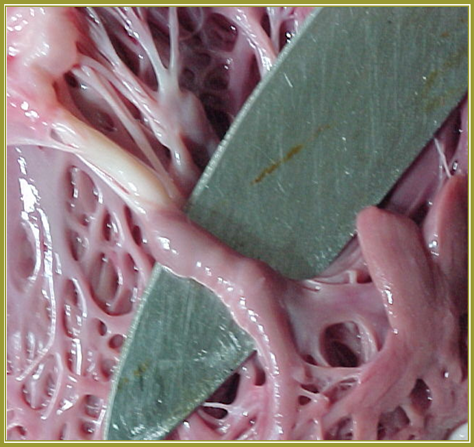 Imagen No. 5 - Fibrosis de la cuerda. Fusin y torsin de msculos papilares.